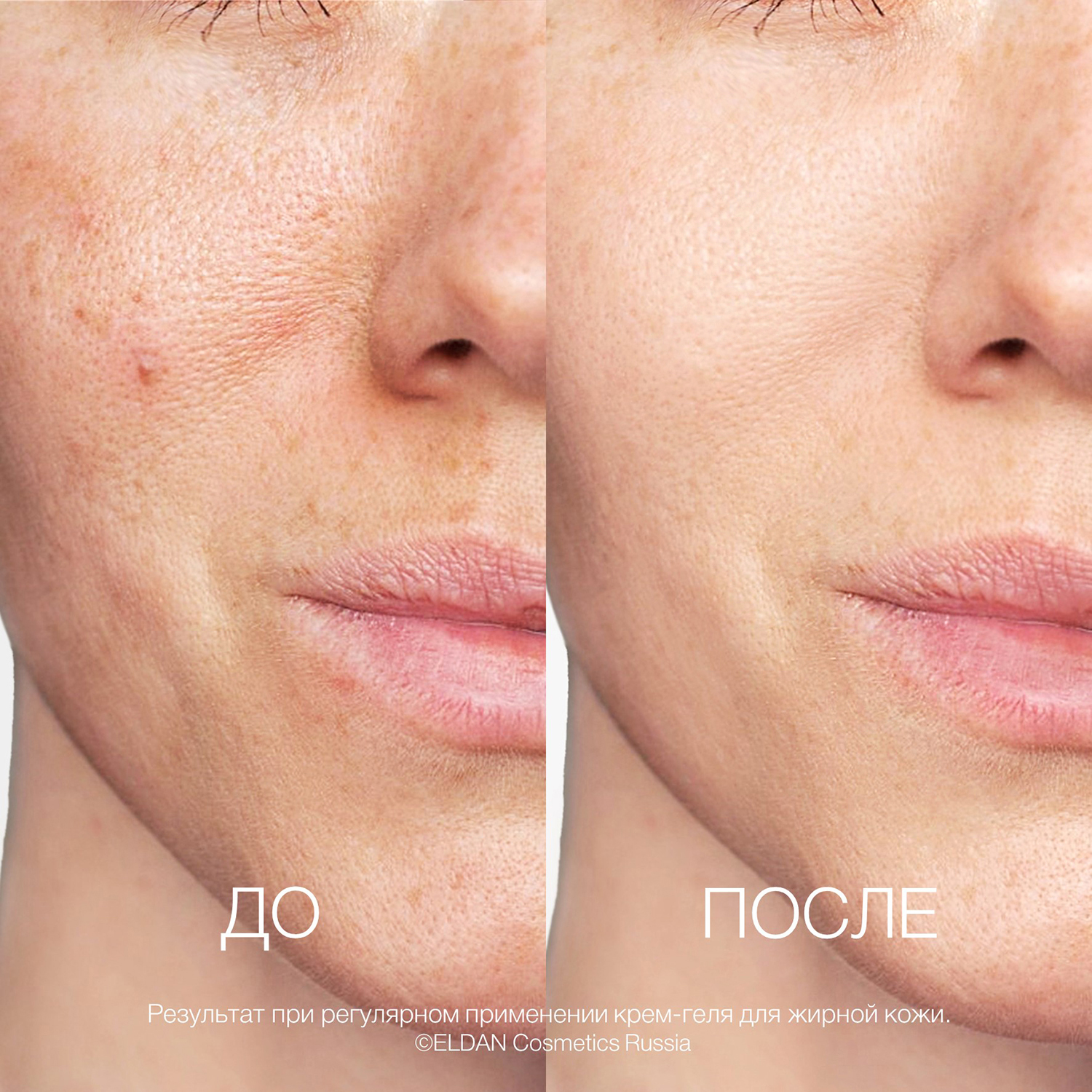 Крем гель для жирной кожи До-после сайт.jpg Крем гель для жирной кожи До-после сайт.jpg